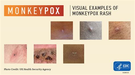 monkeypox rash description