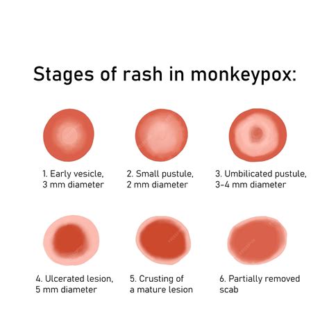 monkeypox rash pictures early stages