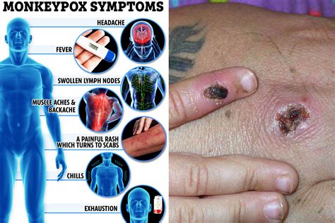 monkeypox symptoms pictures in humans