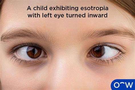 monocular esotropia definition