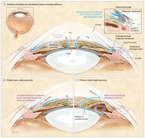 Monocular Glaucoma