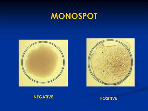 monospot test false positive