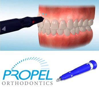 Mops Procedure Dental