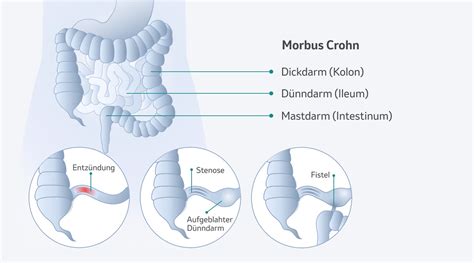 morbus crohn