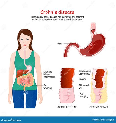 morbus crohn anzeichen