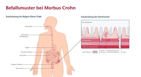 morbus crohn zysten