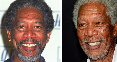 morgan freeman vitiligo