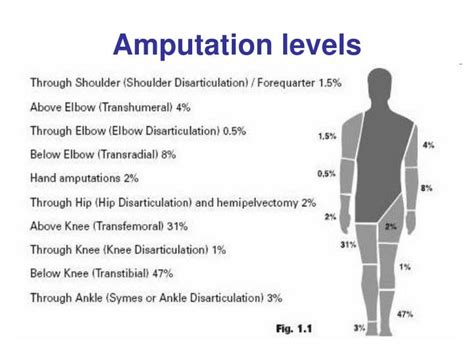 Most Common Reason For Leg Amputation