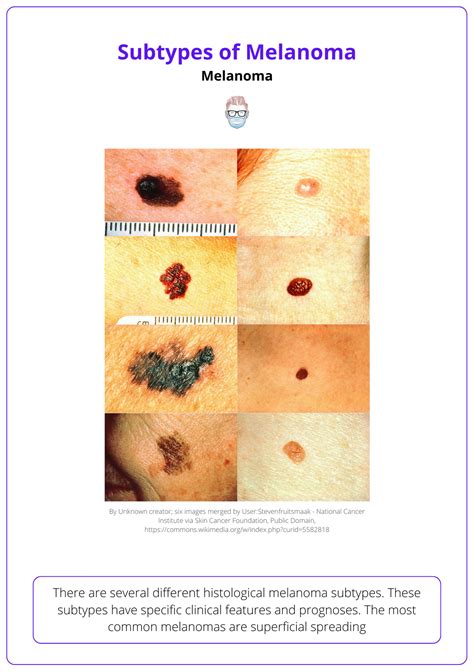 most common subtype of melanoma