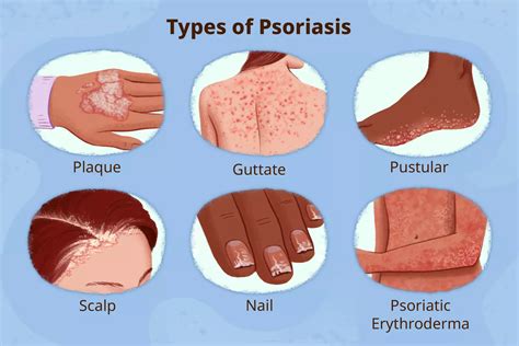 Why Plaque Psoriasis Is The Most Common Type Of Psoriasis