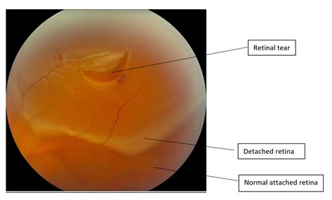 Understanding The Most Common Type Of Retinal Detachment: Symptoms And Treatment