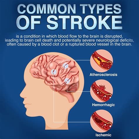 What Is The Most Common Type Of Stroke And Why It Matters