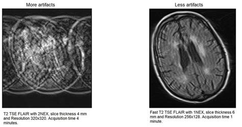 Motion Artifacts In Neuroimaging