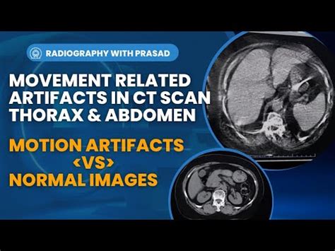 Motion Artifacts Thorax
