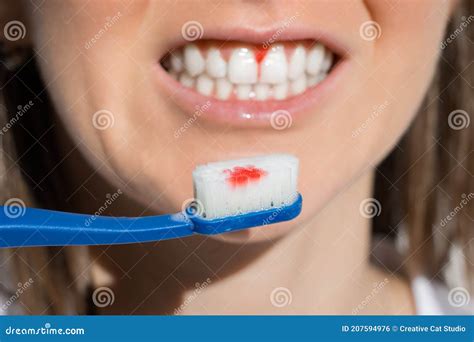 Mouth Bleeding When Brushing Teeth