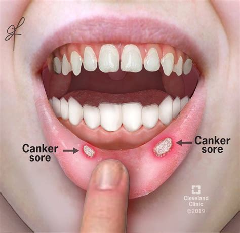 mouth cancer vs canker sore