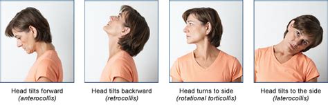 movement therapy for cervical dystonia