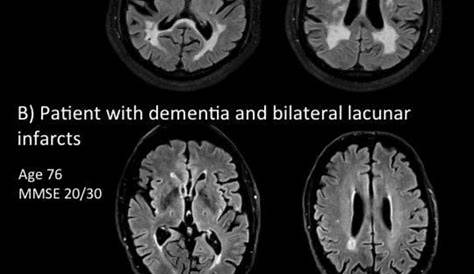 Vascular dementia Image