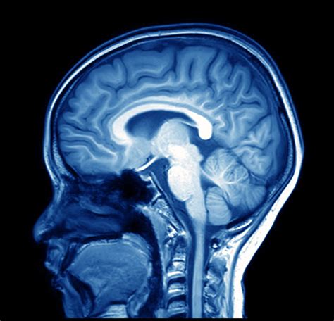 What Does an MRI Brain Scan Reveal About Your Health?