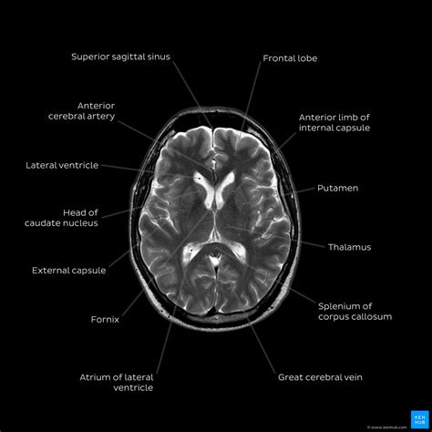 Mri Brain Scan Labeled