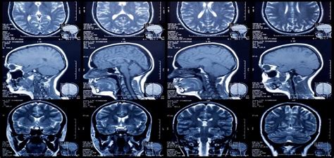 Unlock Early Detection: The Power of MRI Brain Screening