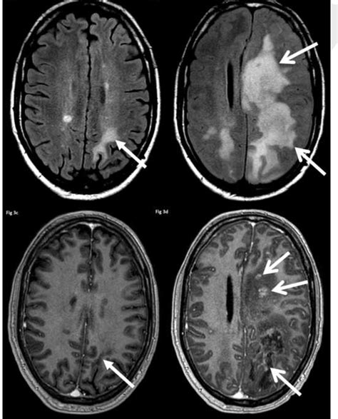 mri brain without contrast multiple sclerosis