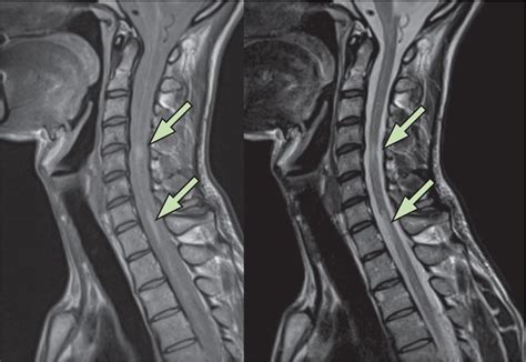 mri c spine of multiple sclerosis