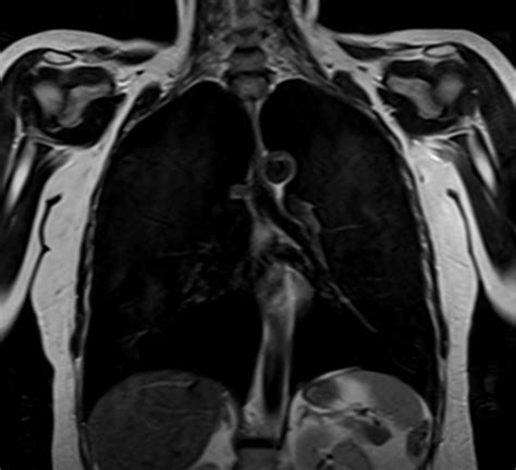 Mri Coronal Chest