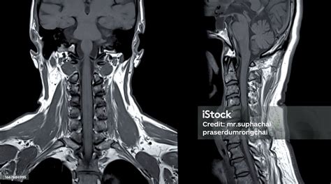 Mri Coronal Neck