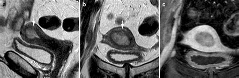 mri pelvic endometrial biopsy