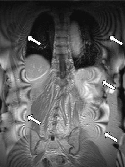 Mri Zebra Artifact