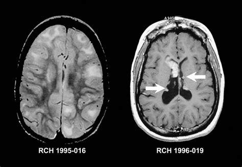 ms mri with contrast