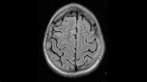 Ms Why Does It Happen