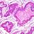 mucinous colorectal adenocarcinoma clinical pathology and