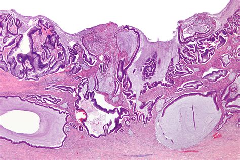 mucinous adenocarcinoma