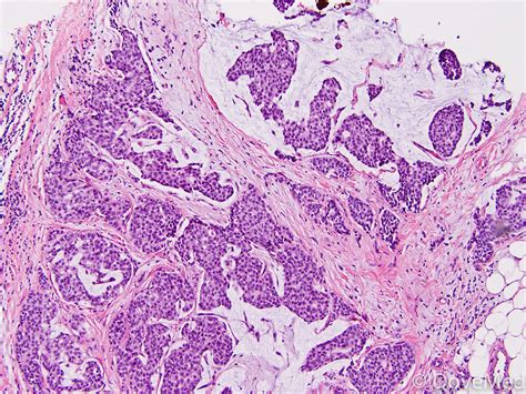 mucinous adenocarcinoma breast