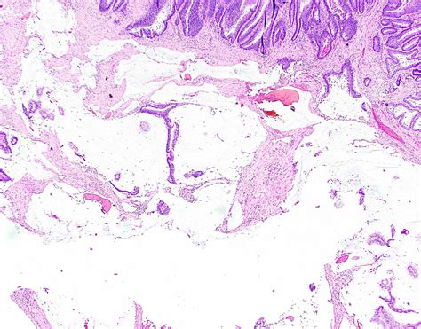 mucinous adenocarcinoma colon pathology