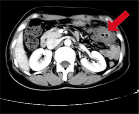 mucinous adenocarcinoma colon radiology
