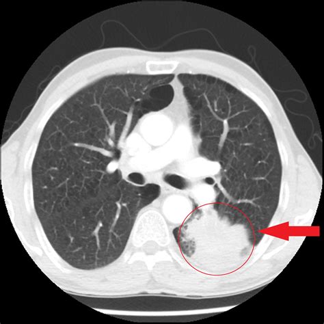 mucinous adenocarcinoma lung cancer