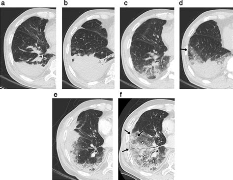 mucinous adenocarcinoma lung radiology