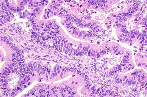 mucinous adenocarcinoma ovary