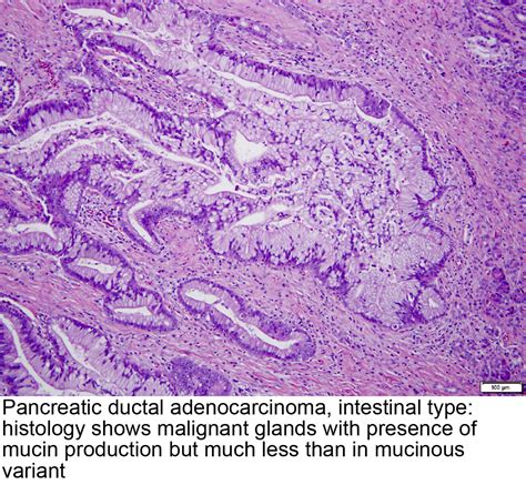 mucinous adenocarcinoma pancreas