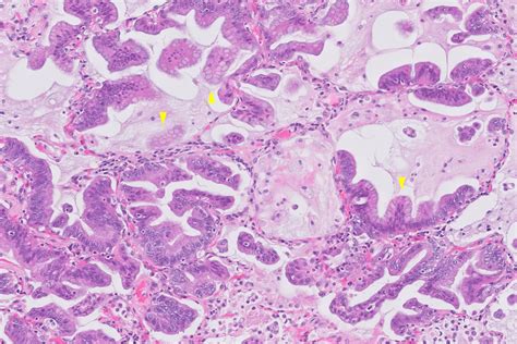 mucinous adenocarcinoma pathology outlines