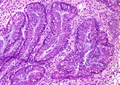 mucinous borderline tumor pathology outlines