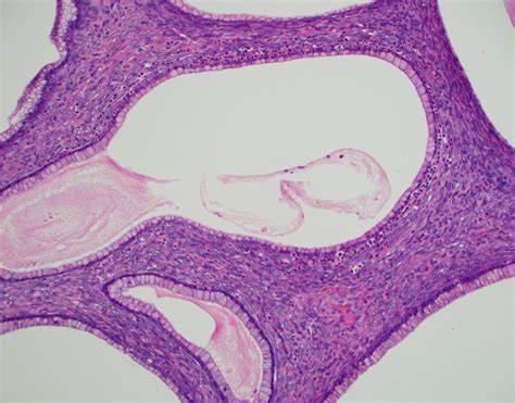 mucinous cystadenoma libre pathology