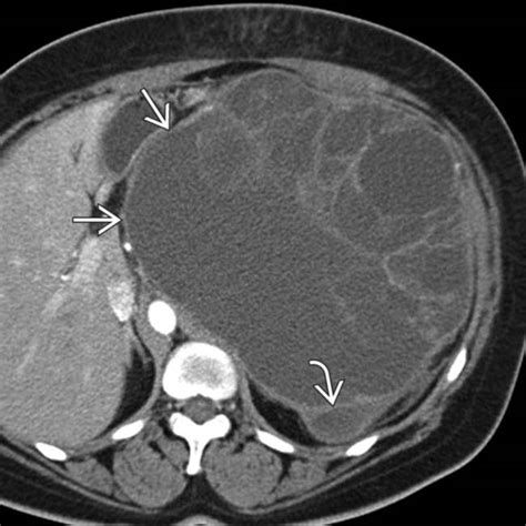 mucinous cystic neoplasm pancreas radiology