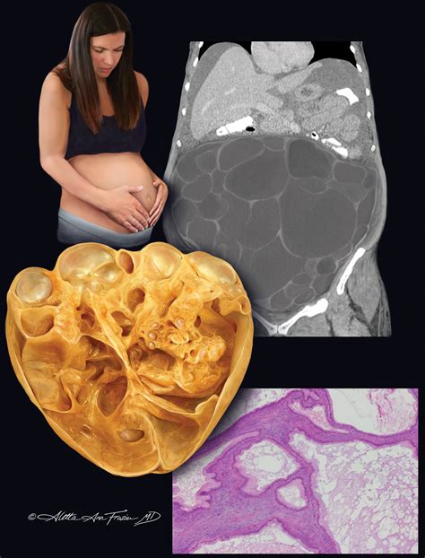mucinous tumor of the ovary