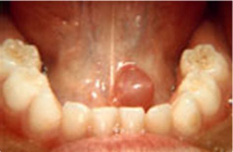 mucocele floor of mouth icd 10
