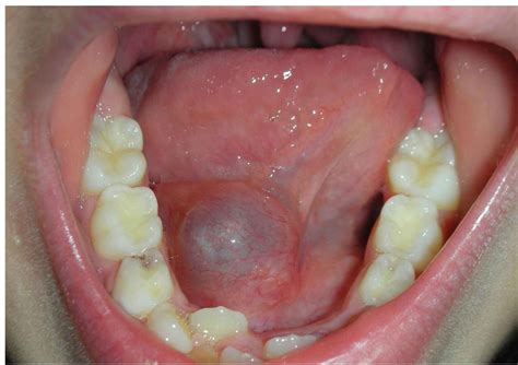 mucocele floor of mouth