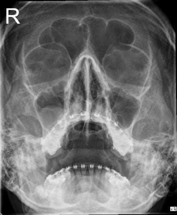 mucous retention cyston floor of maxillary sinus
